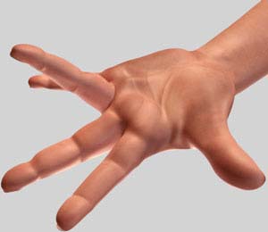 Dupuytren’s Contracture