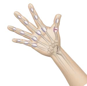 Finger and Thumb Sprain